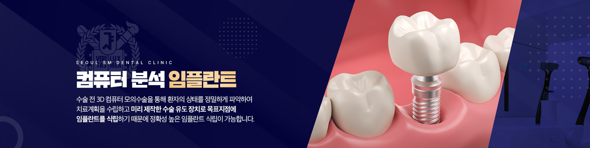 컴퓨터 분석 임플란트-수술 전 3D 컴퓨터 모의수술을 통해 환자의 상태를 정밀하게 파악하여 치료계획을 수립하고 미리 제작한 수술 유도 장치로 목표지점에 임플란트를 식립하기 때문에 정확성 높은 임플란트 식립이 가능합니다.