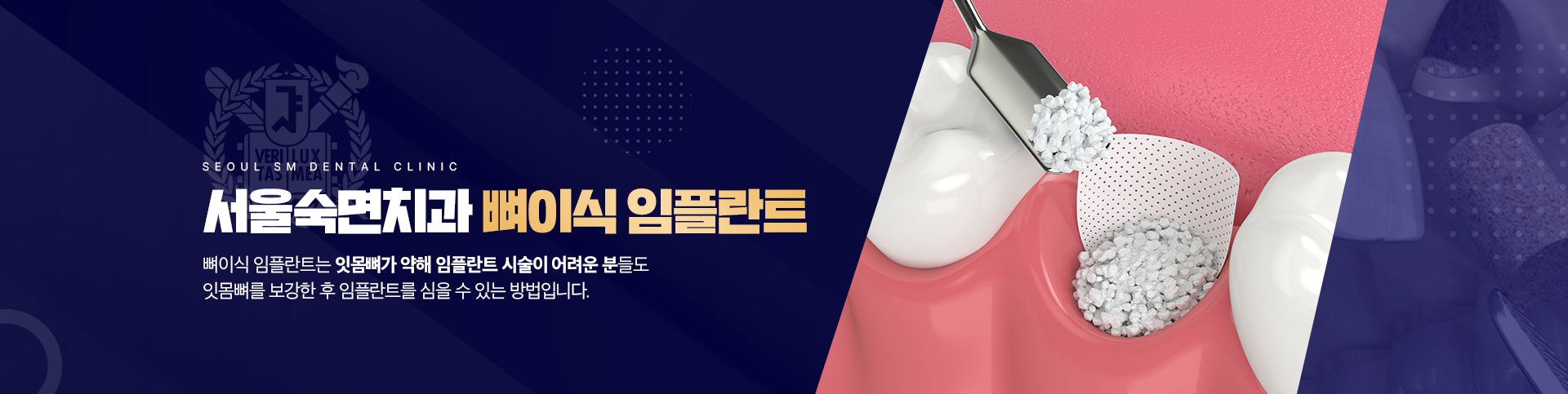 서울숙면치과 뼈이식 임플란트-뼈이식 임플란트는 잇몸뼈가 약해 임플란트 시술이 어려운 분들도 잇몸뼈를 보강한 후 임플란트를 심을 수 있는 방법입니다.