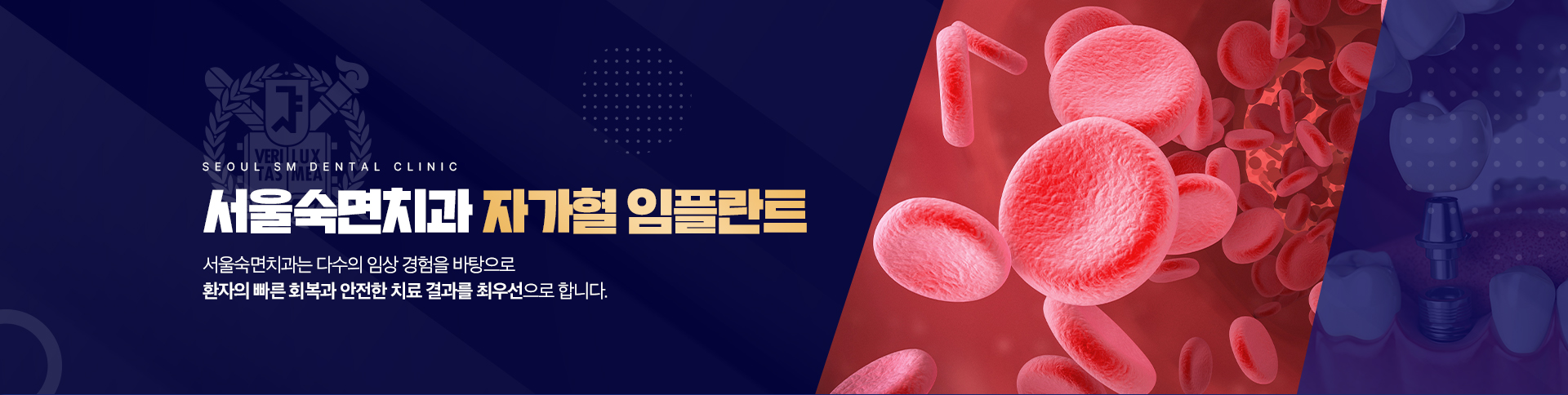 서울숙면치과 자가혈 임플란트-서울숙면치과는 풍부한 임상 경험을 바탕으로 환자의 빠른 회복과 안전한 치료 결과를 최우선으로 합니다.