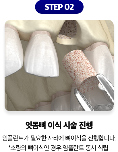 잇몸뼈-이식-시술 진행