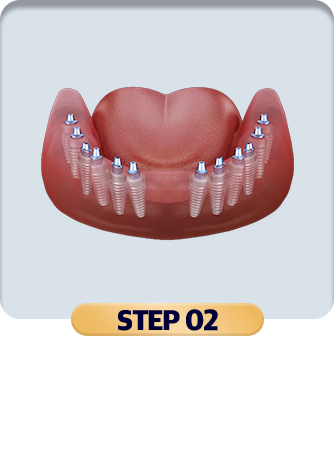 임플란트 식립